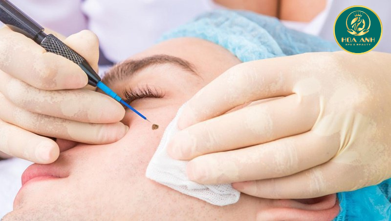 Điều trị sẹo do mụn bằng laser 1